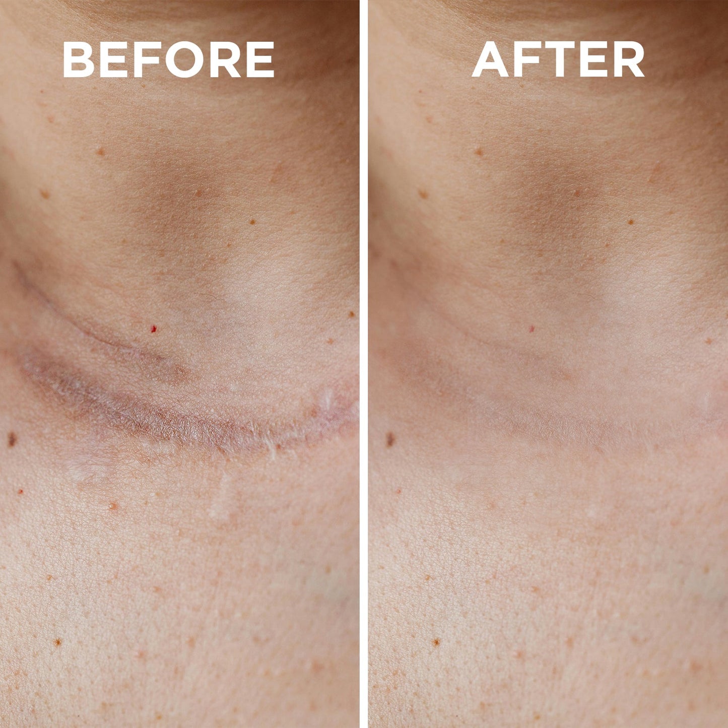 MEDICAL-GRADE SILICONE SCAR RECOVERY SHEETS